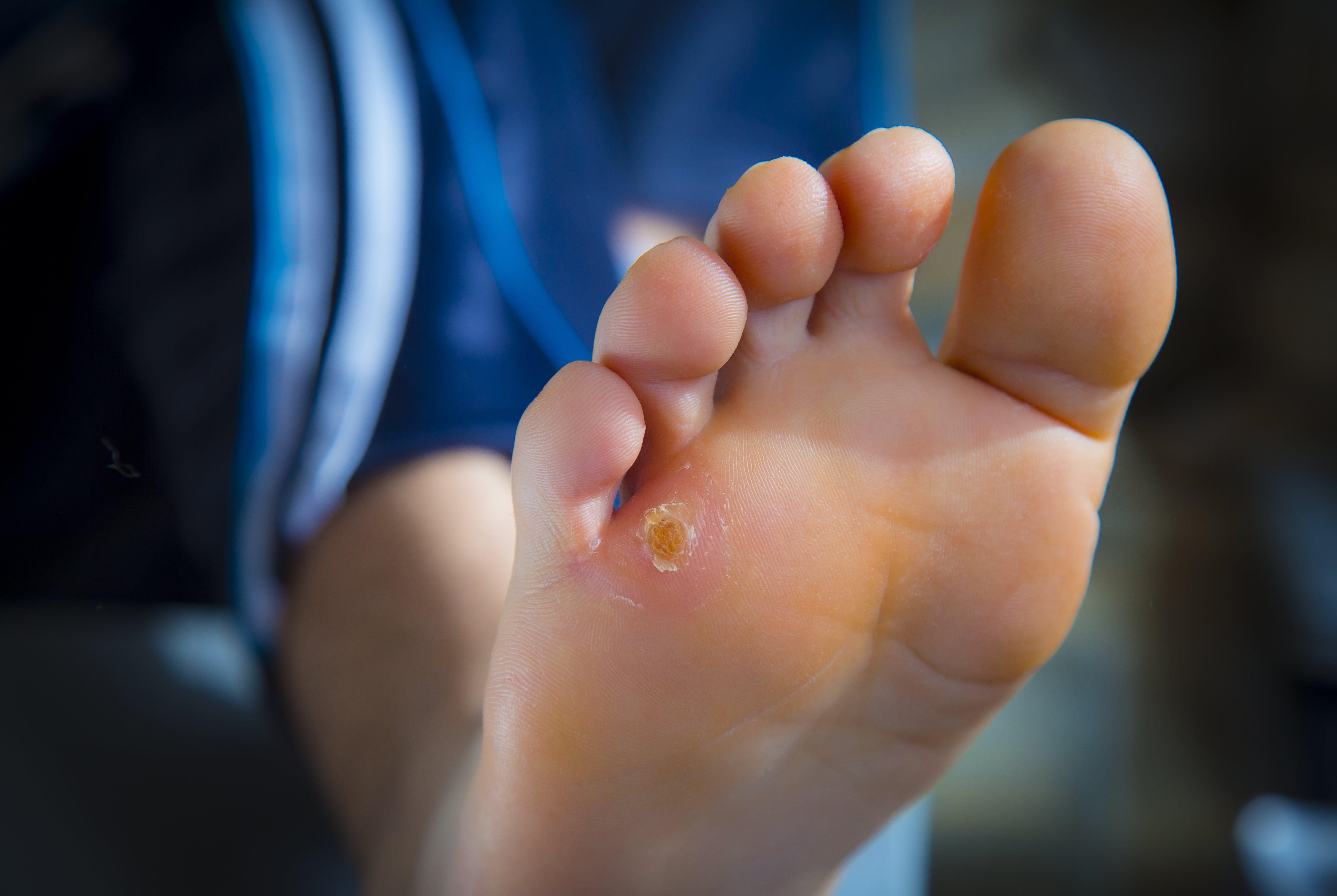Nahaufnahme vom Fuß einer Frau mit schmerzhaftem Hühnerauge an der Fußsohle