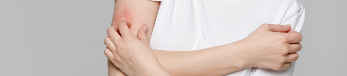 Frau kratzt sich am Oberarm