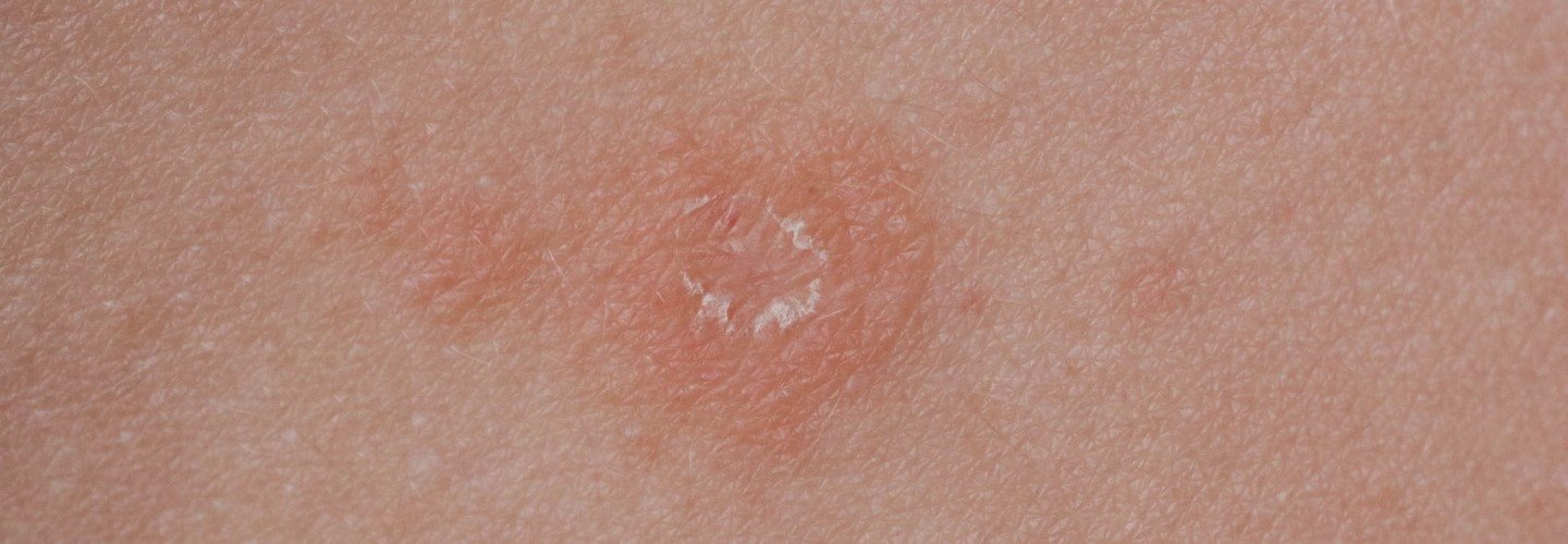 Röschenflechte auf der Haut