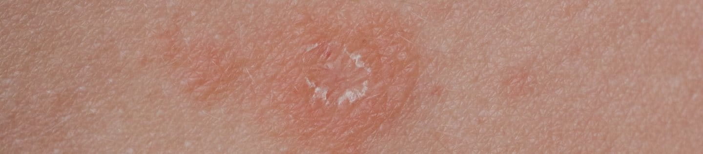 Röschenflechte auf der Haut