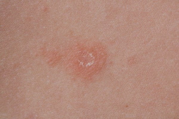 Röschenflechte auf der Haut