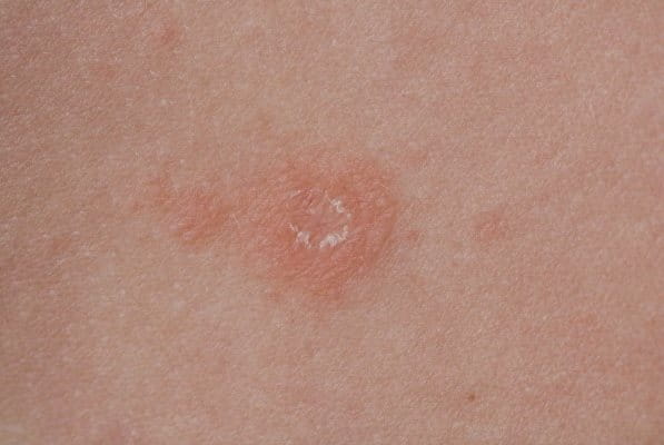 Röschenflechte auf der Haut