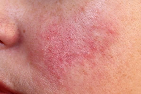 Rosacea fortgeschritten