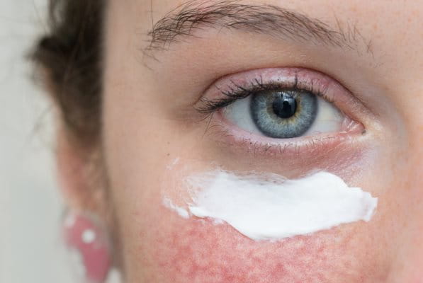 Sonnencreme im Gesicht bei Rosacea