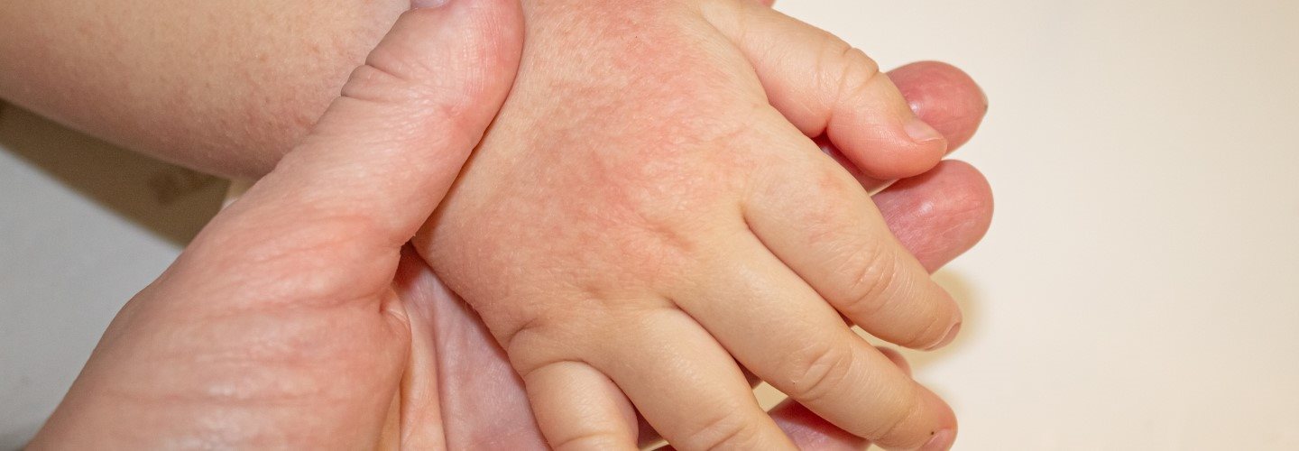 Sonnenallergie auf der Hand eines Kindes