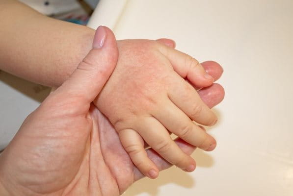 Sonnenallergie auf der Hand eines Kindes