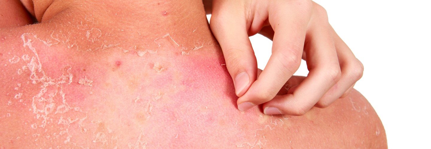 Frau kratzt sich den sonnenverbrannten Rücken