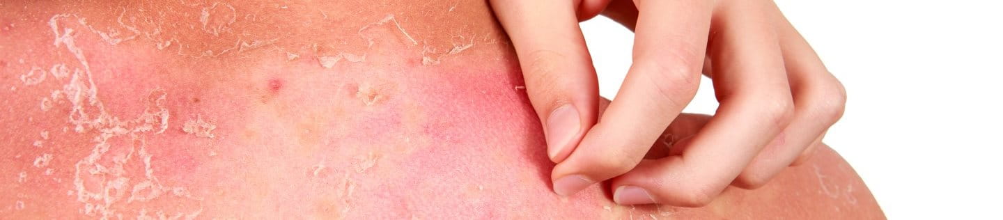 Frau kratzt sich den sonnenverbrannten Rücken