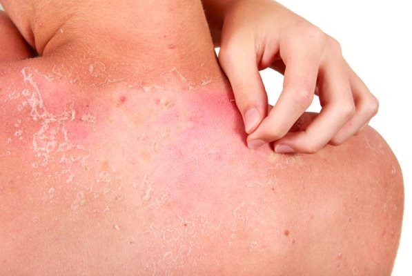 Frau kratzt sich den sonnenverbrannten Rücken