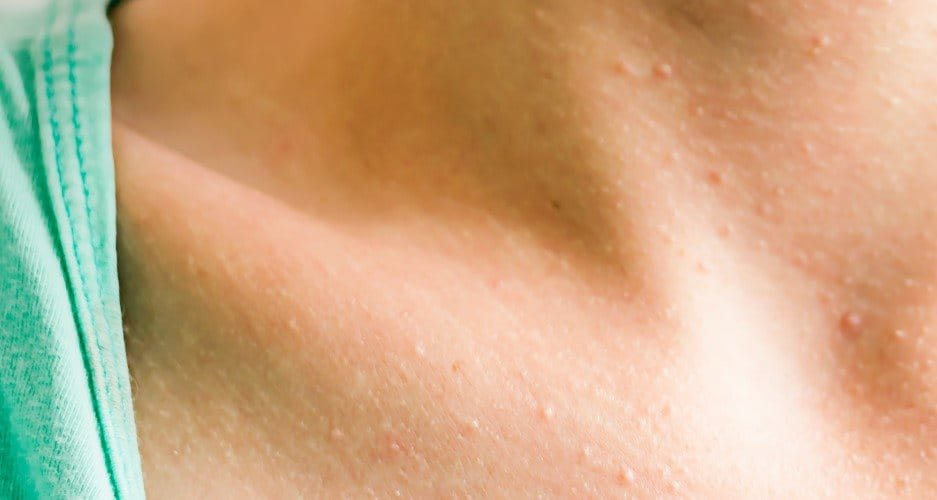 Was sind Hitzepickel und wie entstehen sie? | Eucerin