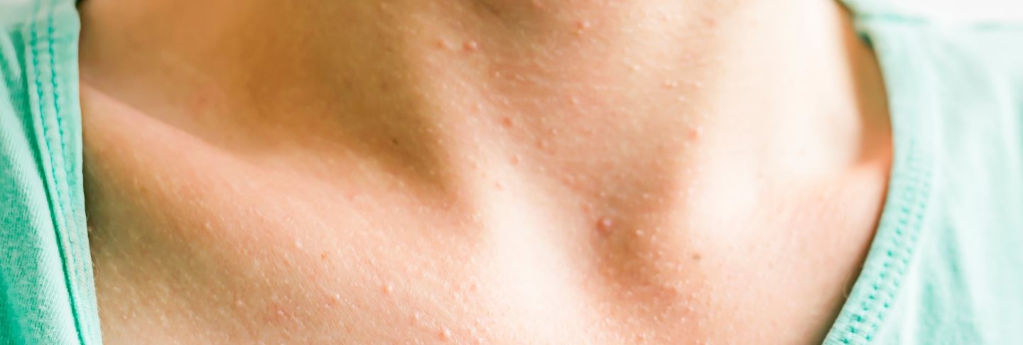Was sind Hitzepickel und wie entstehen sie? | Eucerin
