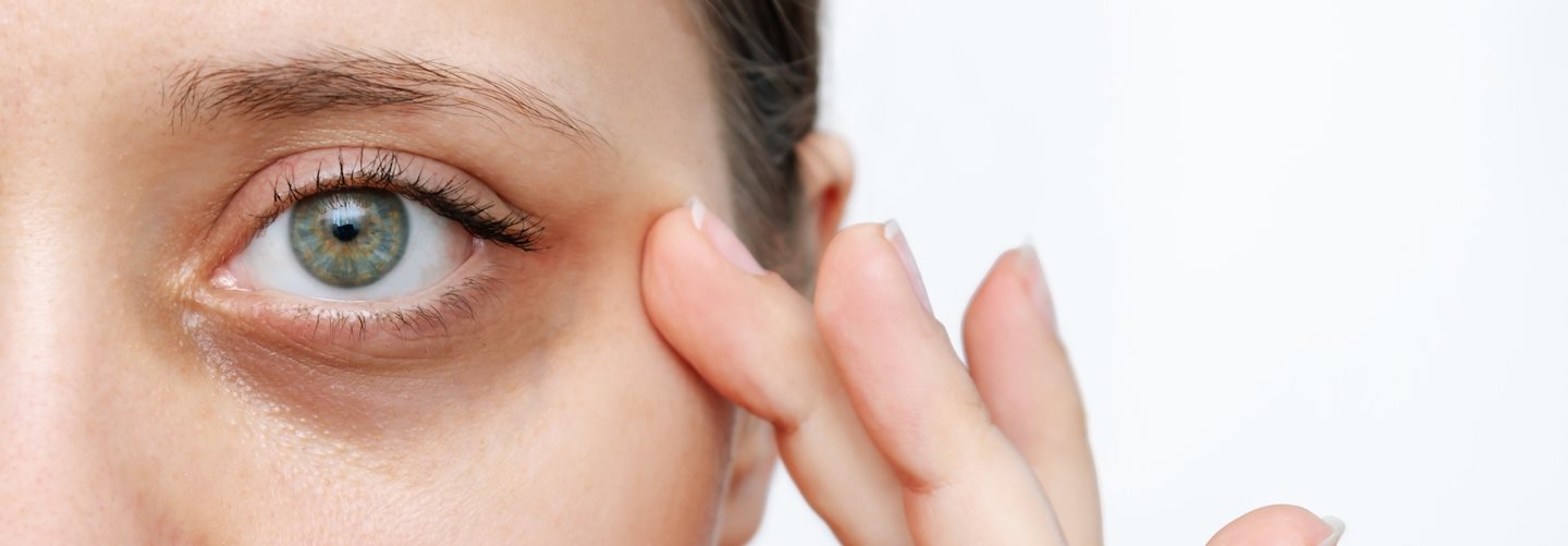 Dunkle Augenringe entstehen oft als Begleiterscheinung von Schlafmangel, Stress oder Erkrankungen. Erfahre hier, was du gegen Augenringe tun kannst. 