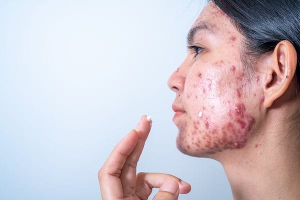 Frau zeigt im Gesicht das typische Bild einer zystischen Akne