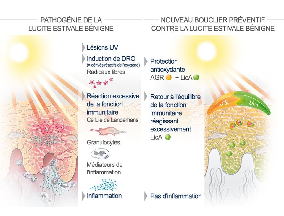 Lucite Estivale Bénigne ou Allergie au soleil| EUCERIN