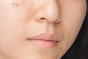 hiperpigmentacijske mrlje