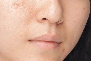 hiperpigmentacijske mrlje