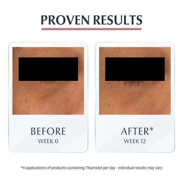 Comparison between two images showing a dark under-eye before using Eucerin Even Pigment Perfector Eye Care and after using it