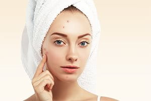 Woman acne face without sensitive skin