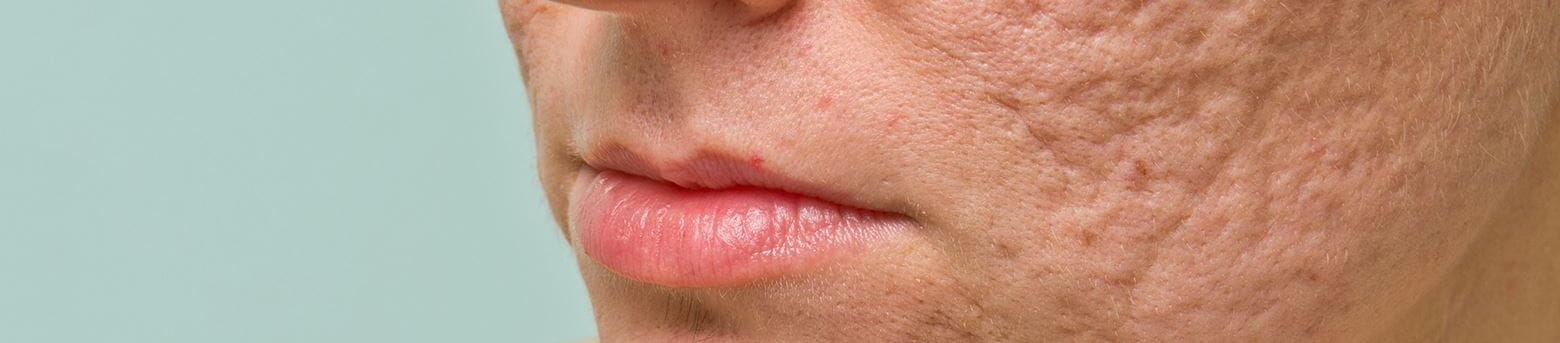Acne scars on face