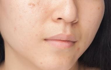 acne marks