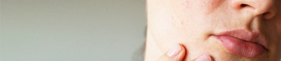 Dealing with acne mark