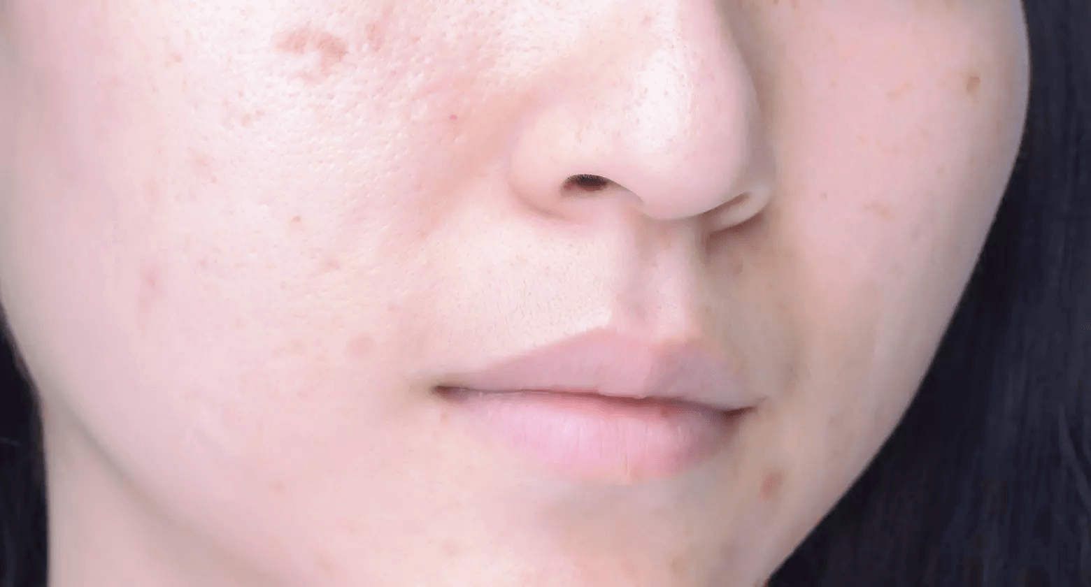 inkt constante Ellendig Acne littekens verminderen | Eucerin