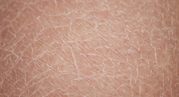 kan zijn ontwikkelen Gebeurt Wanneer heb je een (extreem) droge huid? En wat kan je eraan doen? | Eucerin