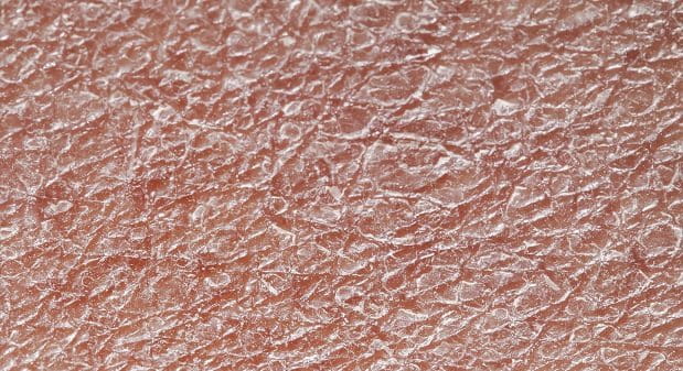 Banzai Extractie procedure Wanneer heb je een (extreem) droge huid? En wat kan je eraan doen? | Eucerin
