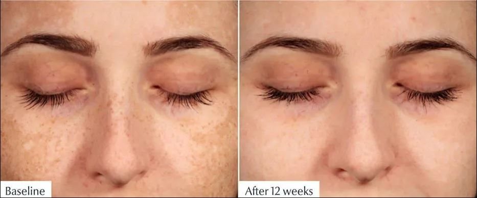 Eucerin Anti-Pigment resultaat - before & after