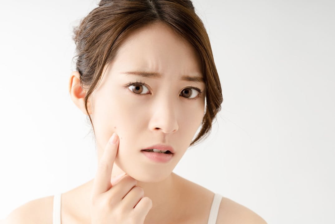 ฝ้า กระ กระลึก