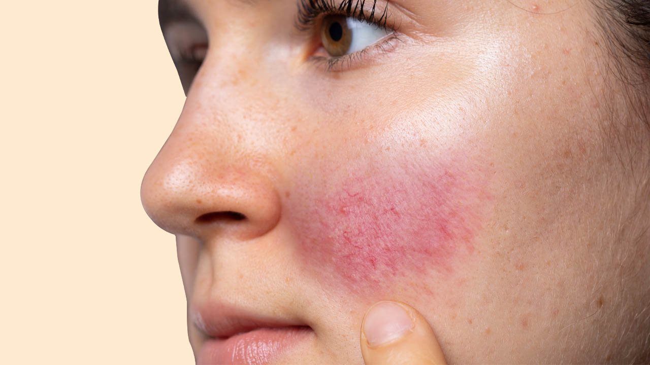 โรคเซ็บเดิร์ม