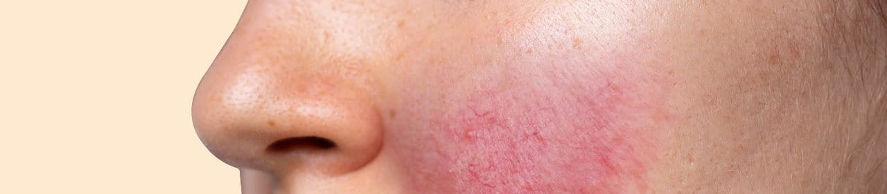 เซ็บเดิร์ม