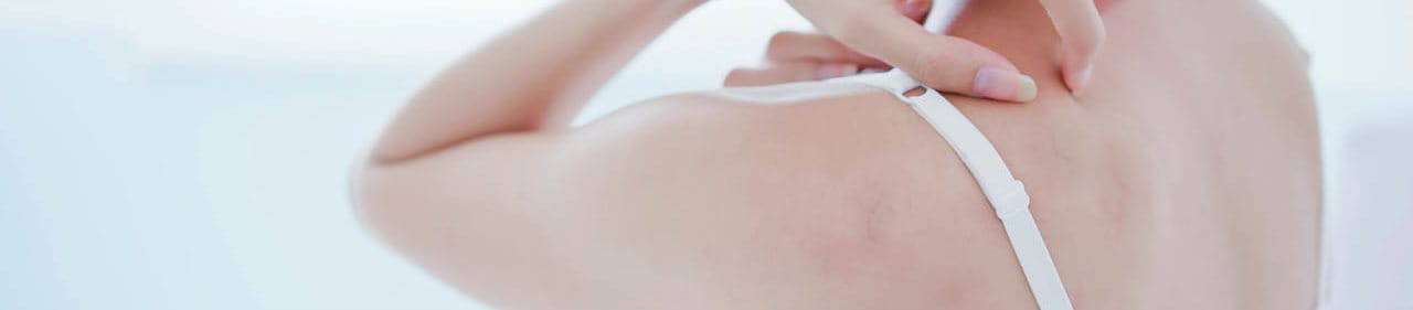 ผื่นแพ้อากาศ