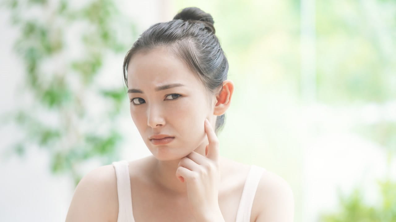 สิวสเตียรอยด์