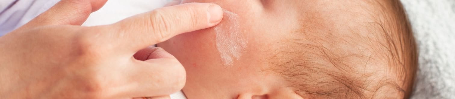 ทารกผิวลอก