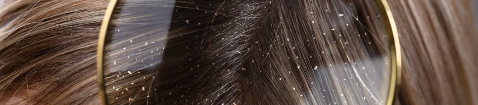 เชื้อราบนหนังศีรษะ เป็นต้นเหตุของอาการคันหัวรึเปล่า