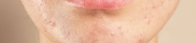 สิวเชื้อรา