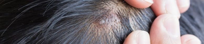 สิวที่หัวเกิดจากอะไร