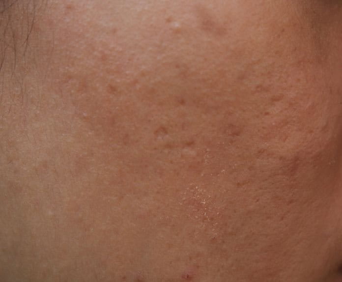 หลุมสิว