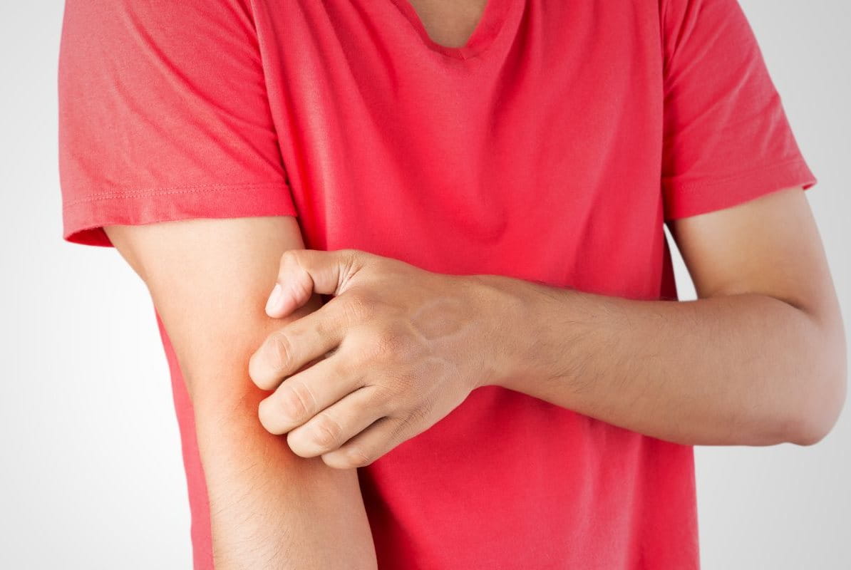 สิวที่แขน