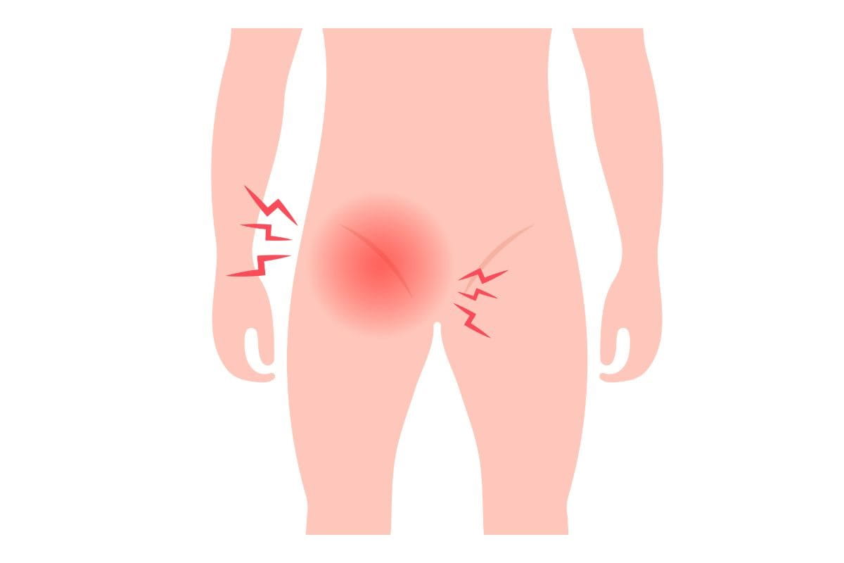 สังคัง Tinea Cruris