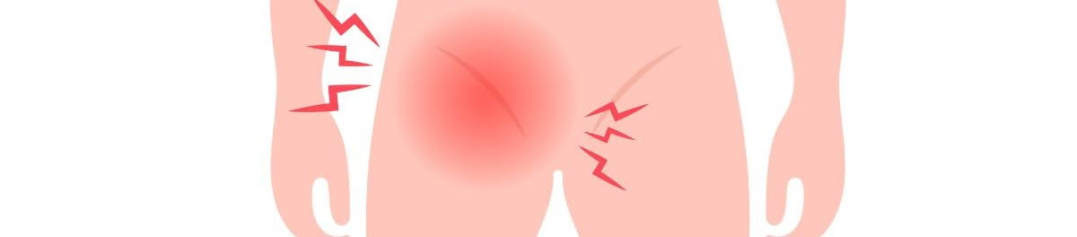 สังคัง Tinea Cruris