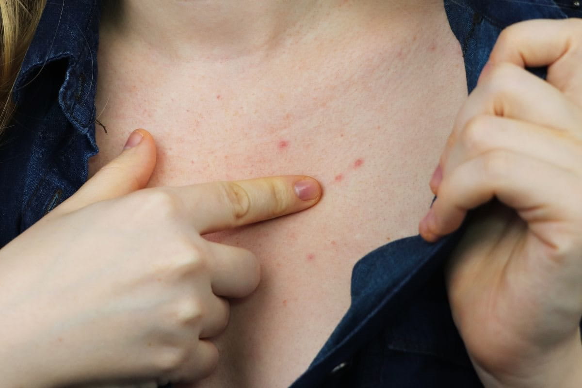 สิวที่หน้าอก