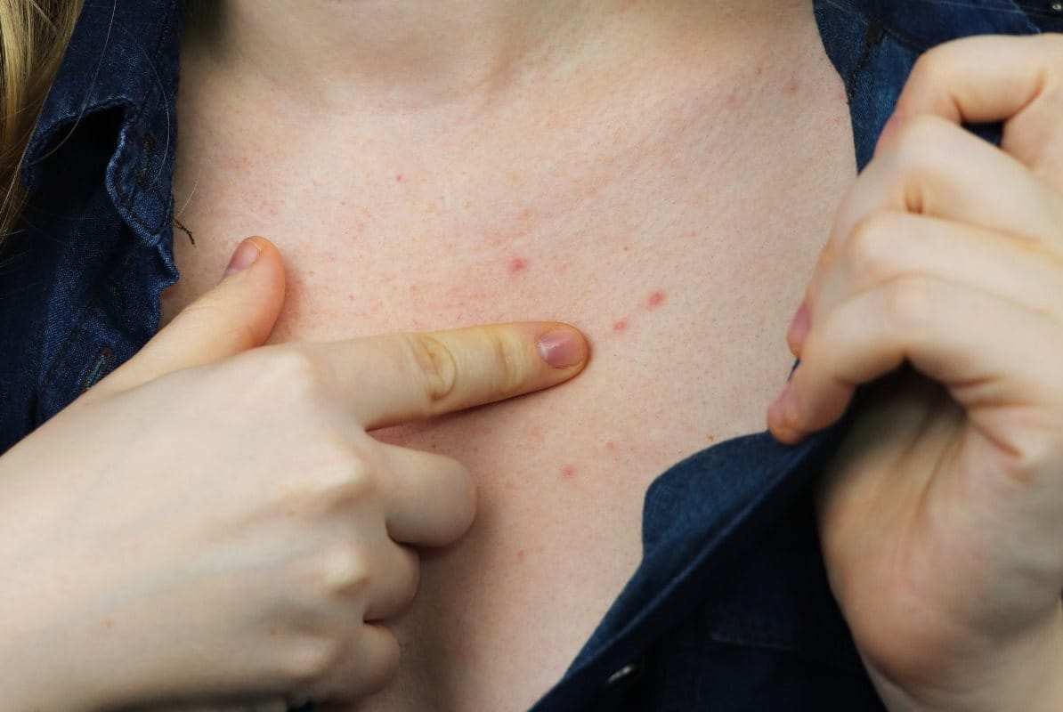 สิวที่หน้าอก