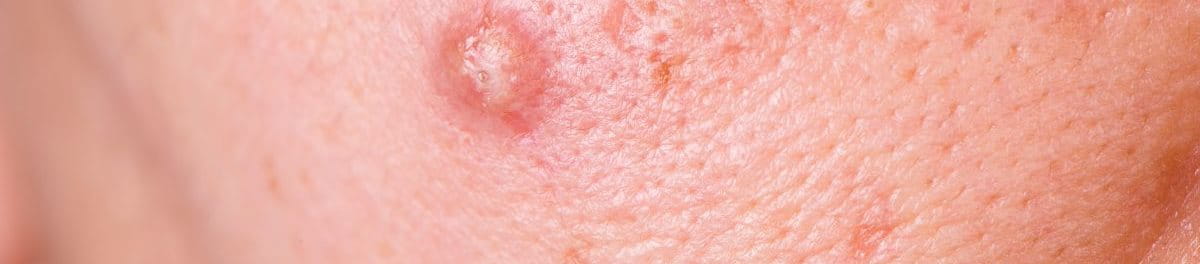 สิว ซีสต์