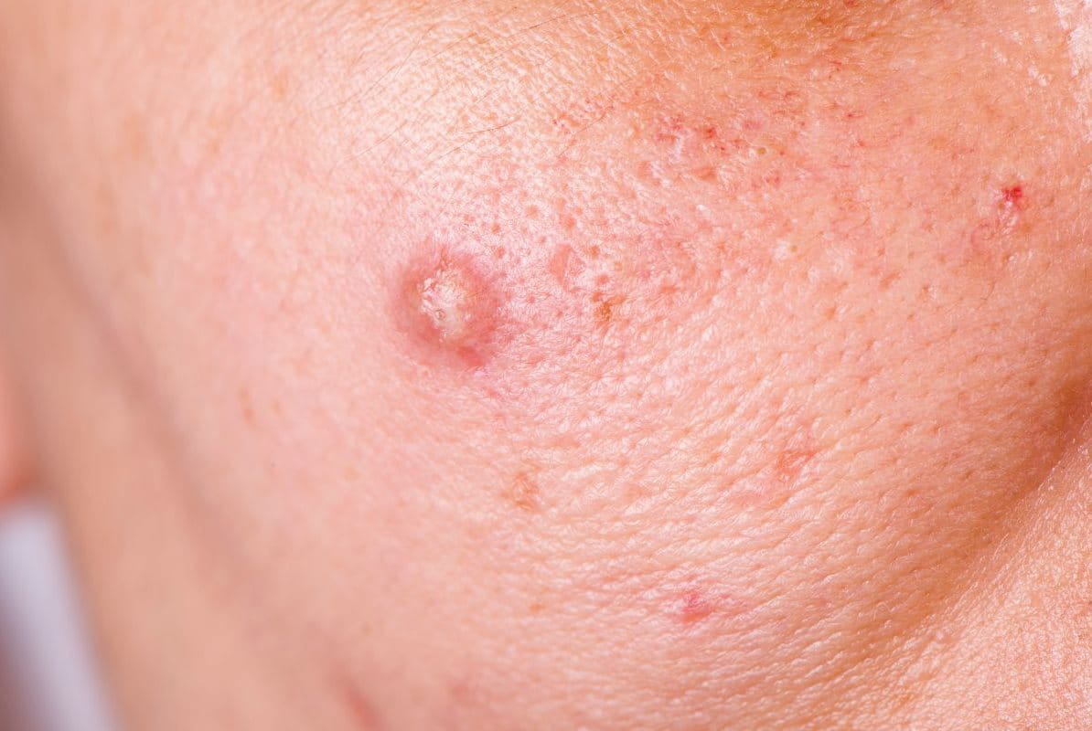 สิว ซีสต์