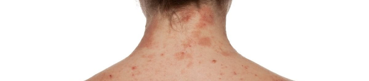 วิธีรักษาผิวหนังอักเสบด้วยตัวเอง