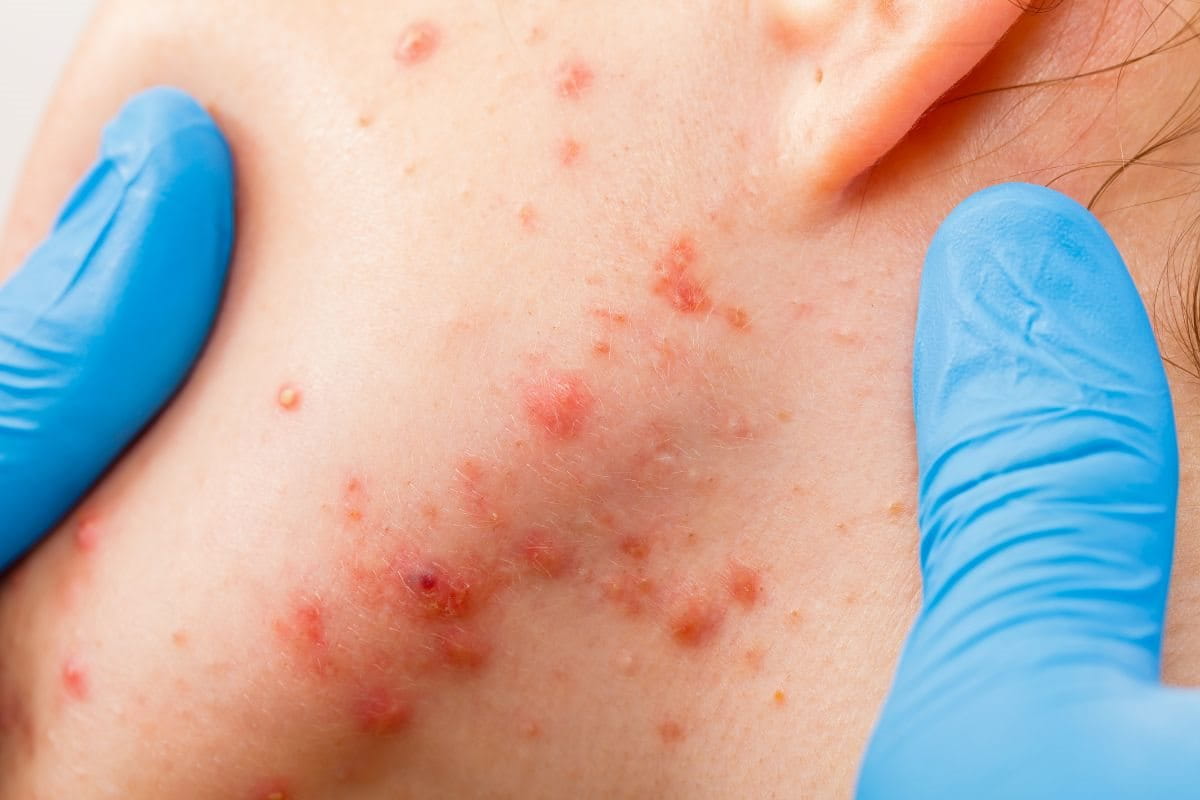  สิวขึ้นกรอบหน้า