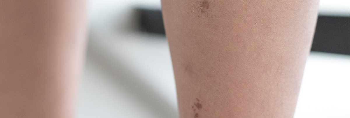 น้ำเหลืองไม่ดี คืออะไร อาการเป็นอย่างไร