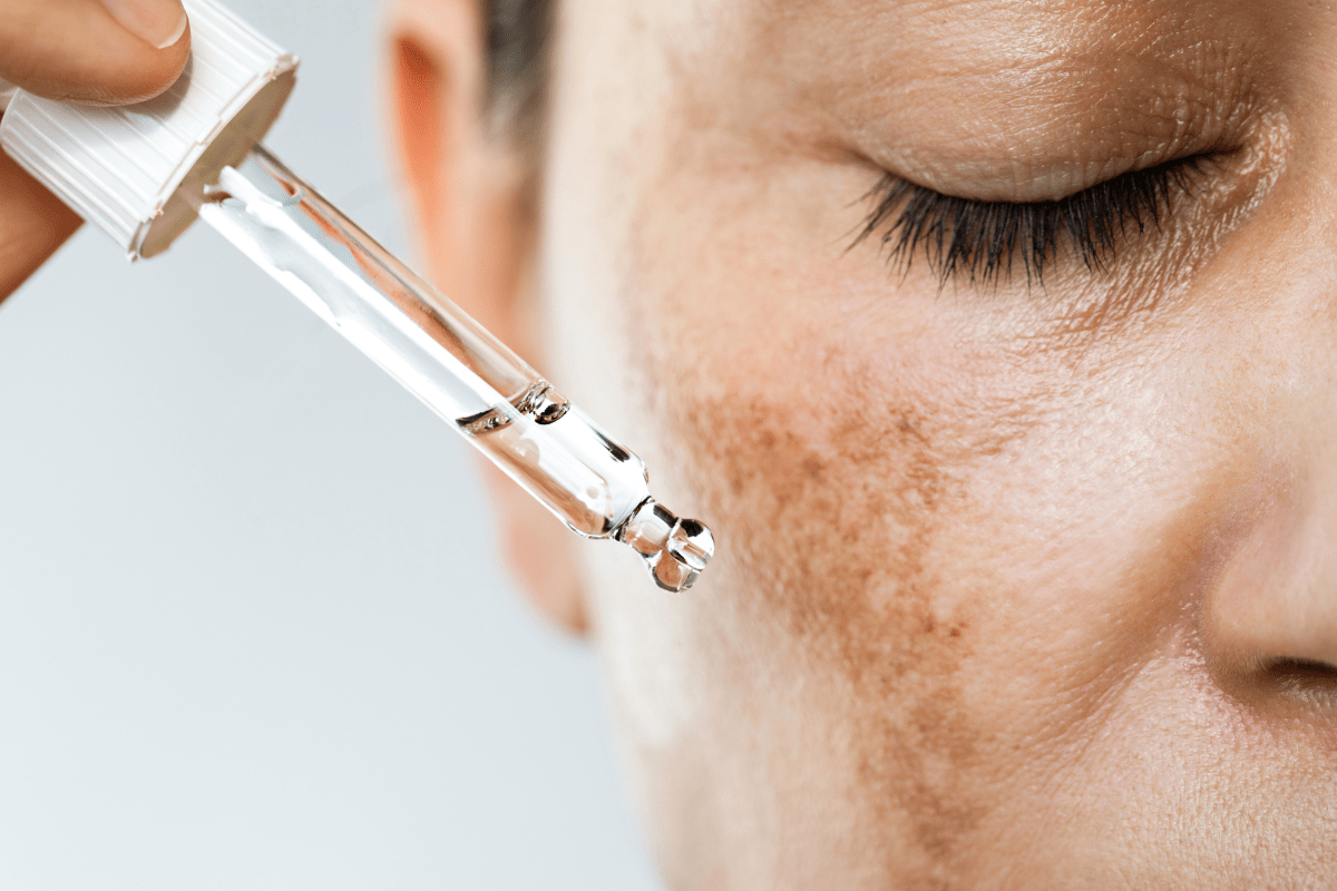 วิธีรักษาฝ้า